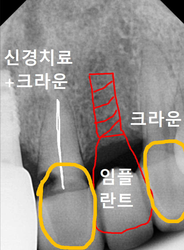 음식물 끼임, 거뭇한 무언가 보인다면? 이미 늦었을 수 있습니다. 관련 이미지 9