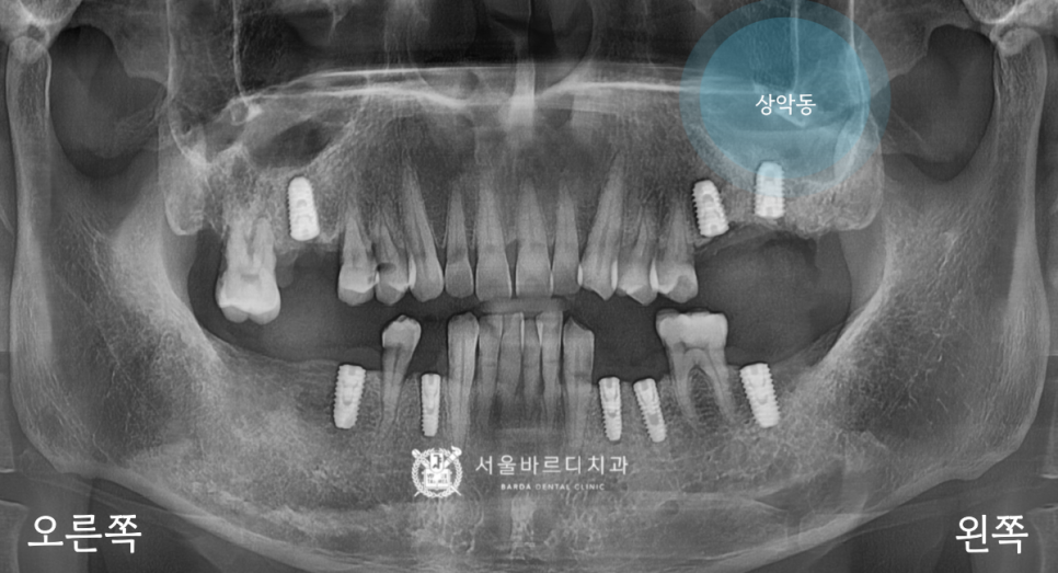 고덕동치과 서울바르디치과 무절개 네비게이션 임플란트 치료증례 #1 관련 이미지 12