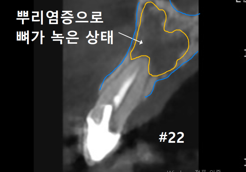 강동구 재신경치료, 왜 첫 치료보다 성공률이 낮다고 할까요? 관련 이미지 5