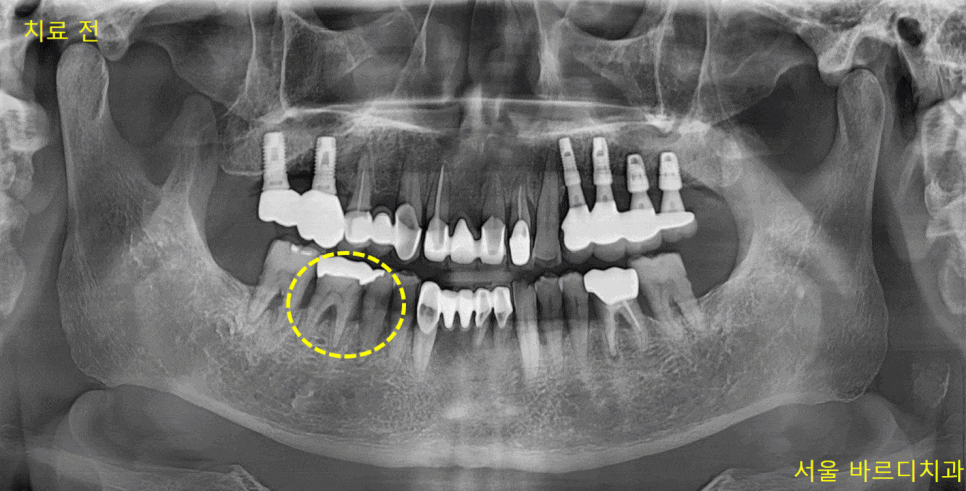 강동구 임플란트 후 술 언제부터 마실 수 있나요? 관련 이미지 1