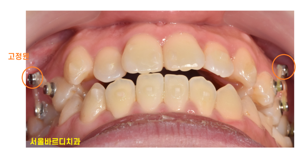 교정중 미니스크류 필수일까? 투명교정도 때로는 필요하다 관련 이미지 6