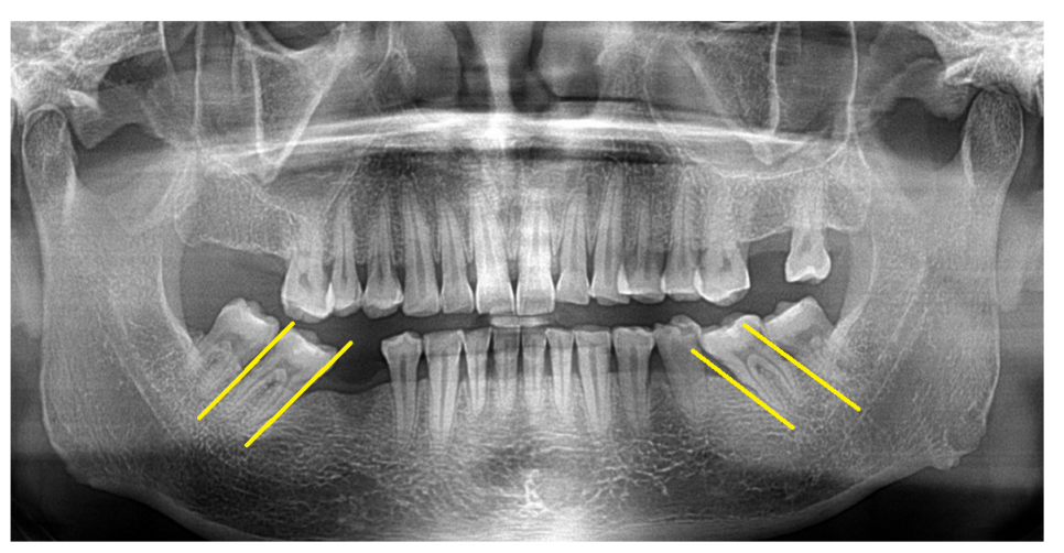 암사동 치과 임플란트 꼭 안 해도 되는 경우 궁금증 해결해 드려요 관련 이미지 15