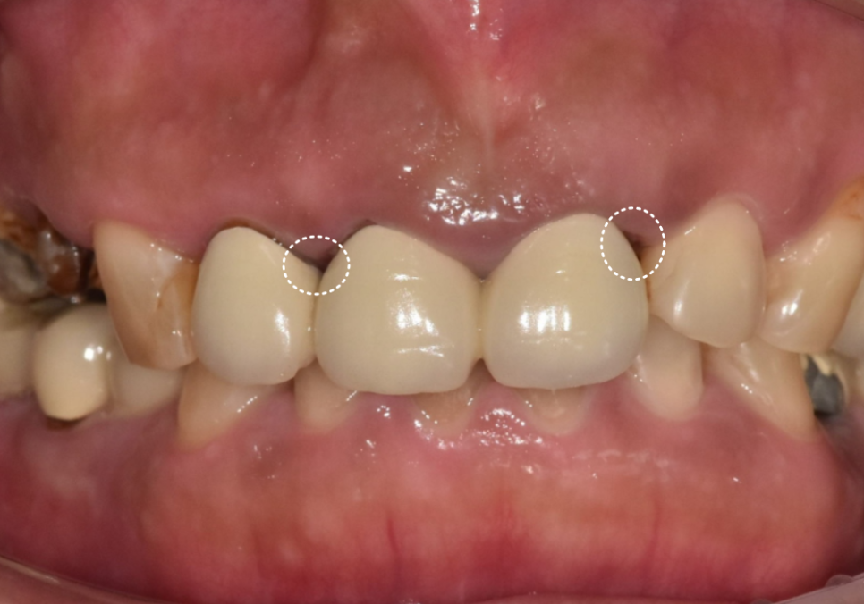 강동구 오래된 보철, 교체 시기는? 아프지 않은데 꼭 바꿔야 하나요? 관련 이미지 11