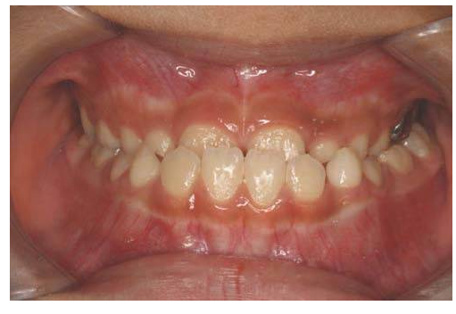 고덕동 교정치과 부정교합은 무엇인가요? 어떨때 치료가 필요한가요? 관련 이미지 3