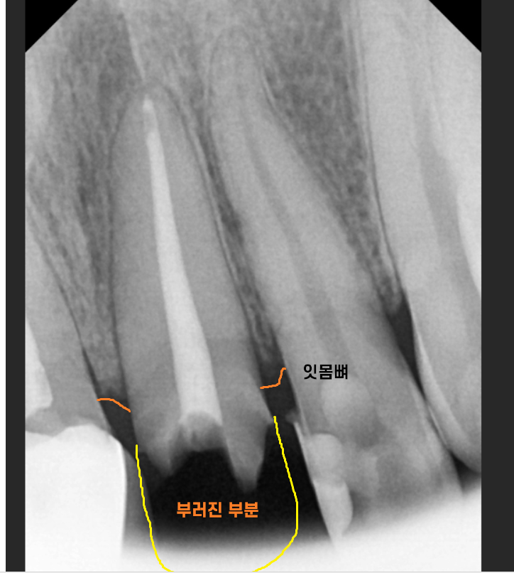 앞니 부러짐 손상이 커서 하남선동치과에서 임플란트 치료 관련 이미지 5