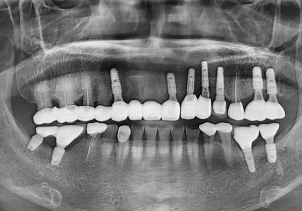 앞니 브릿지 탈락, 씌워둔 게 빠졌어요. 다시 붙일 수 있을까요? 관련 이미지 16