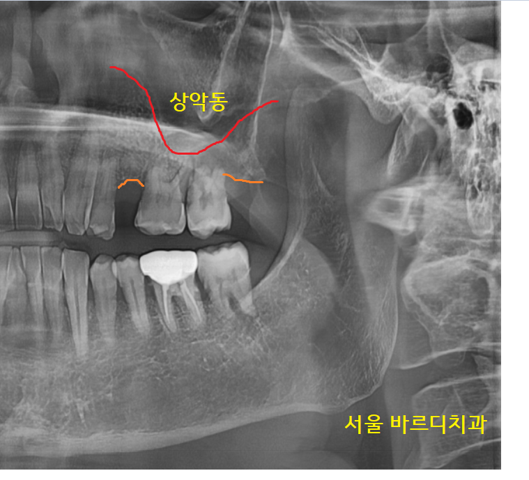 덕풍동 치과 임플란트 불가 판정받으신 환자분 살렸습니다. 관련 이미지 3