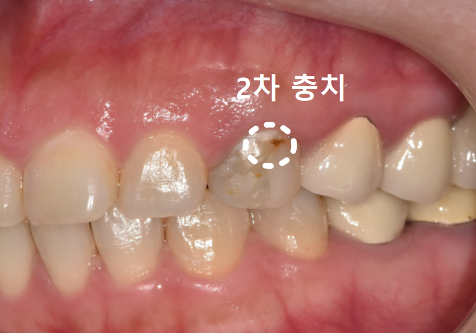 앞니가 검게 변색된 이유, 신경치료 후 꼭 크라운으로 씌워야 하는 걸까요? 관련 이미지 6