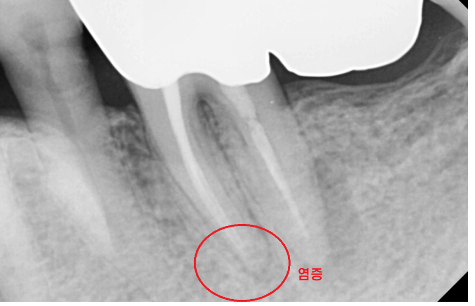 강일동 임플란트 씌운 치아 통증 불편할 때는 치과를 방문해주세요 관련 이미지 4