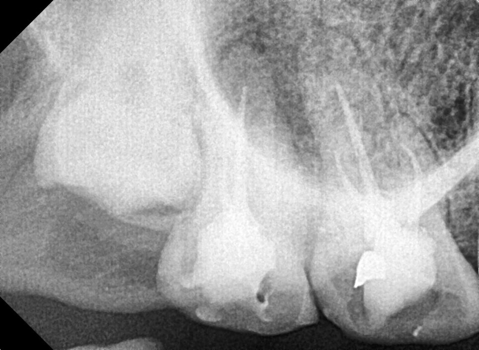 치아 뿌리 염증 빼야 된다는 치아, 이렇게 살렸습니다. 치료 방법 관련 이미지 8