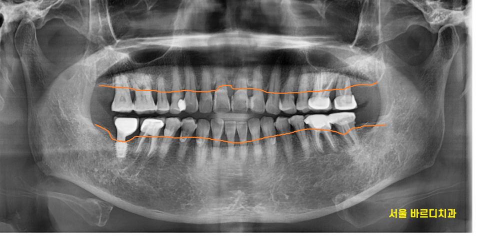 고덕동 치과 어금니 흔들림과 통증 임플란트가 답일 때! 관련 이미지 3