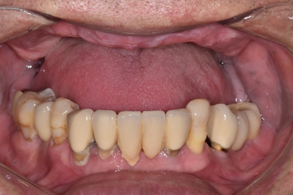 얇은 잇몸뼈, 임플란트 거부 당했다면? 상악동거상술로 해결할 수 있습니다. 관련 이미지 1