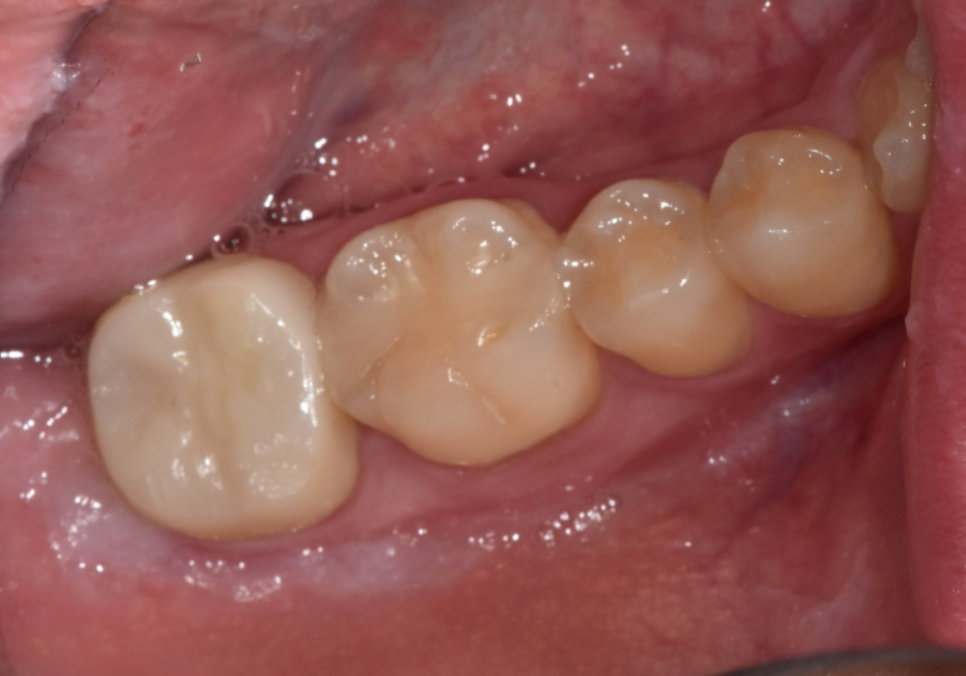 고덕동 사랑니 매복 발치, 안 아픈데 꼭 빼야 하나요? 관련 이미지 16