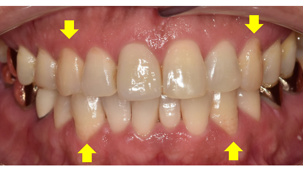 Pediatric Orthodontic Treatment for Impacted Canines Is Needed to Guide Proper Eruption. image 1