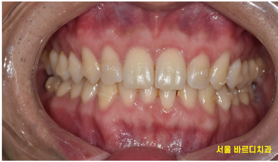 미사 치아교정 군인도 할 수 있을까요?? 투명교정을 추천합니다. 관련 이미지 3