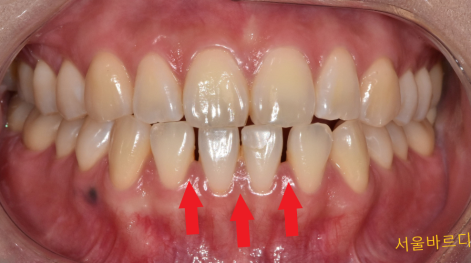 벌어진 아래 앞니 라미네이트로 감쪽같게 치료했습니다. 관련 이미지 2
