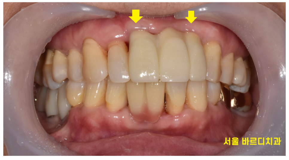 상일동역 치과 윗니 앞니 흔들림 임플란트로 심미까지 잡았습니다. 관련 이미지 13