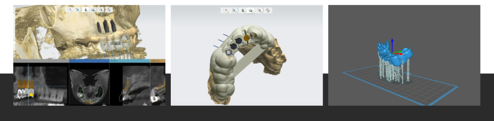 서울 네비게이션 임플란트 치과 불안할 때 좋은 선택지가 될 수 있습니다. 관련 이미지 2