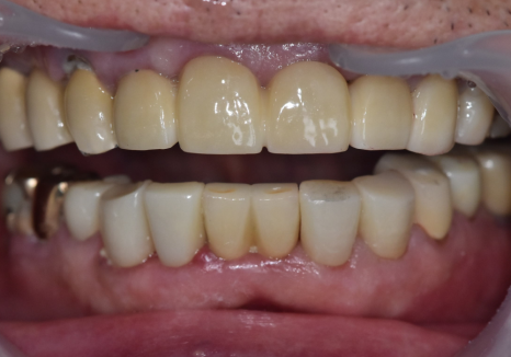 앞니 음식물 끼임, 왜 젊을 때보다 더 자주 발생하는 걸까요? 까맣게 변한 앞니 치료 사례 관련 이미지 16