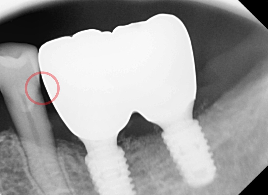 고덕동치과 임플란트 정기검진, 미루다가 수십만 원 손해 봅니다. 관련 이미지 4
