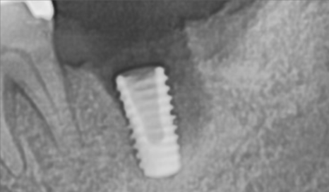 바르디 임플란트는 바르게 심지만, 빠르게 씹습니다. 그간의 경험을 바탕으로요. 관련 이미지 9