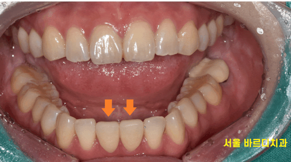 벌어진 아래 앞니 라미네이트로 감쪽같게 치료했습니다. 관련 이미지 1