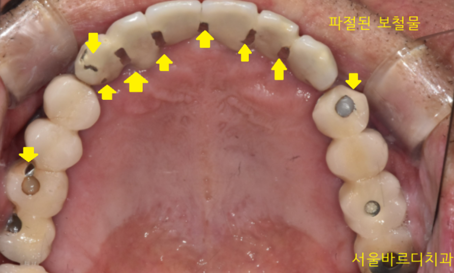 천호동 치과 임플란트 크라운 종류 설명 나갑니다. 관련 이미지 6