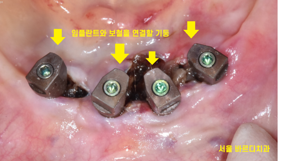 상일동 근처 치과 얇은뼈 틀니 안될 때 해결 방법은?? 관련 이미지 9
