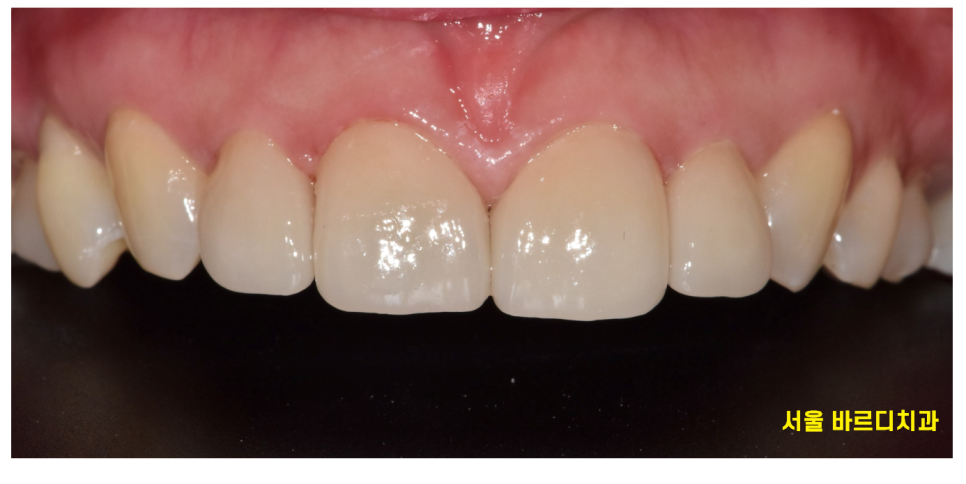 왜소치 라미네이트 작은 치아 콤플렉스 말끔하게 극복해요!! 관련 이미지 7