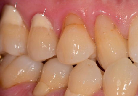 치아 시림 증상 때문에 고민이신가요? 그렇다면 양치질 너무 열심히 하지 마세요. 관련 이미지 4