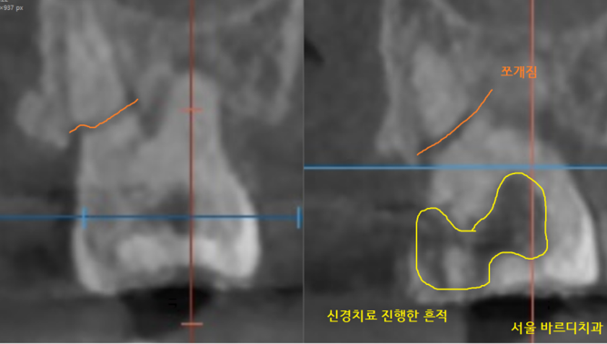 미사역 치과 어금니 뿌리 쪼개짐으로 발치 후 임플란트 했습니다! 관련 이미지 5