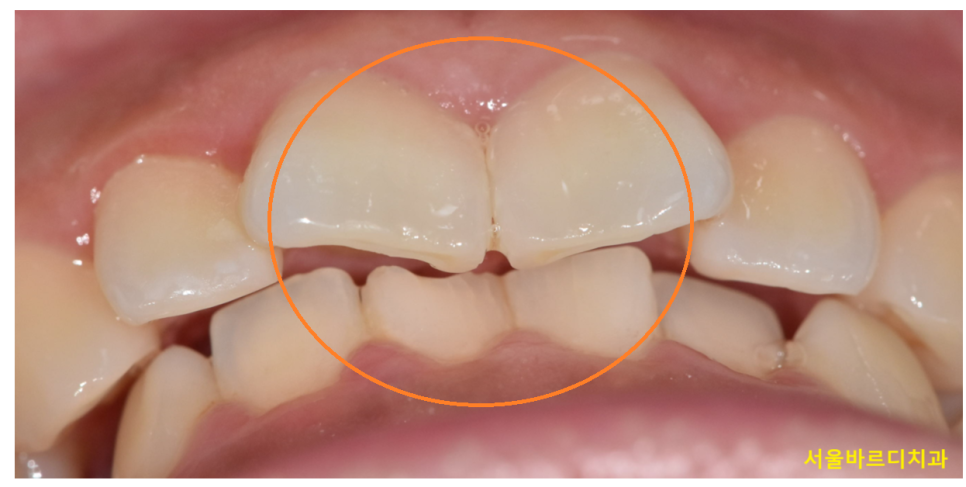 아랫니가 안보여요 과개교합 원인, 문제점 알아보아요! 관련 이미지 2