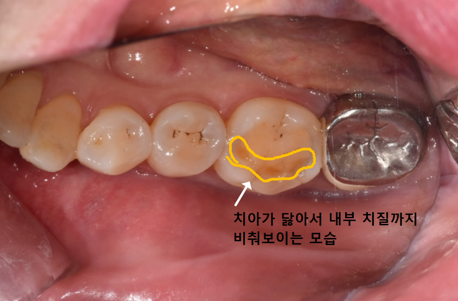 아침에 일어날 때 어금니가 욱신거린다면? 이 습관을 의심해 봐야 합니다. 관련 이미지 2