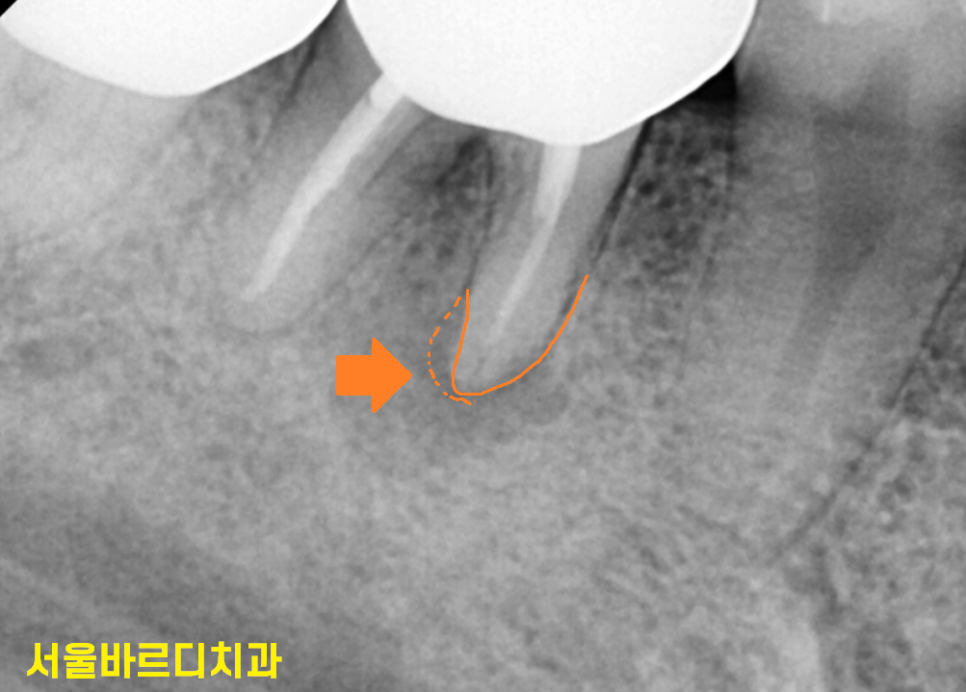 잇몸 물집 강일역 치과에서 원인 알아보고 임플란트로 치료했습니다. 관련 이미지 7