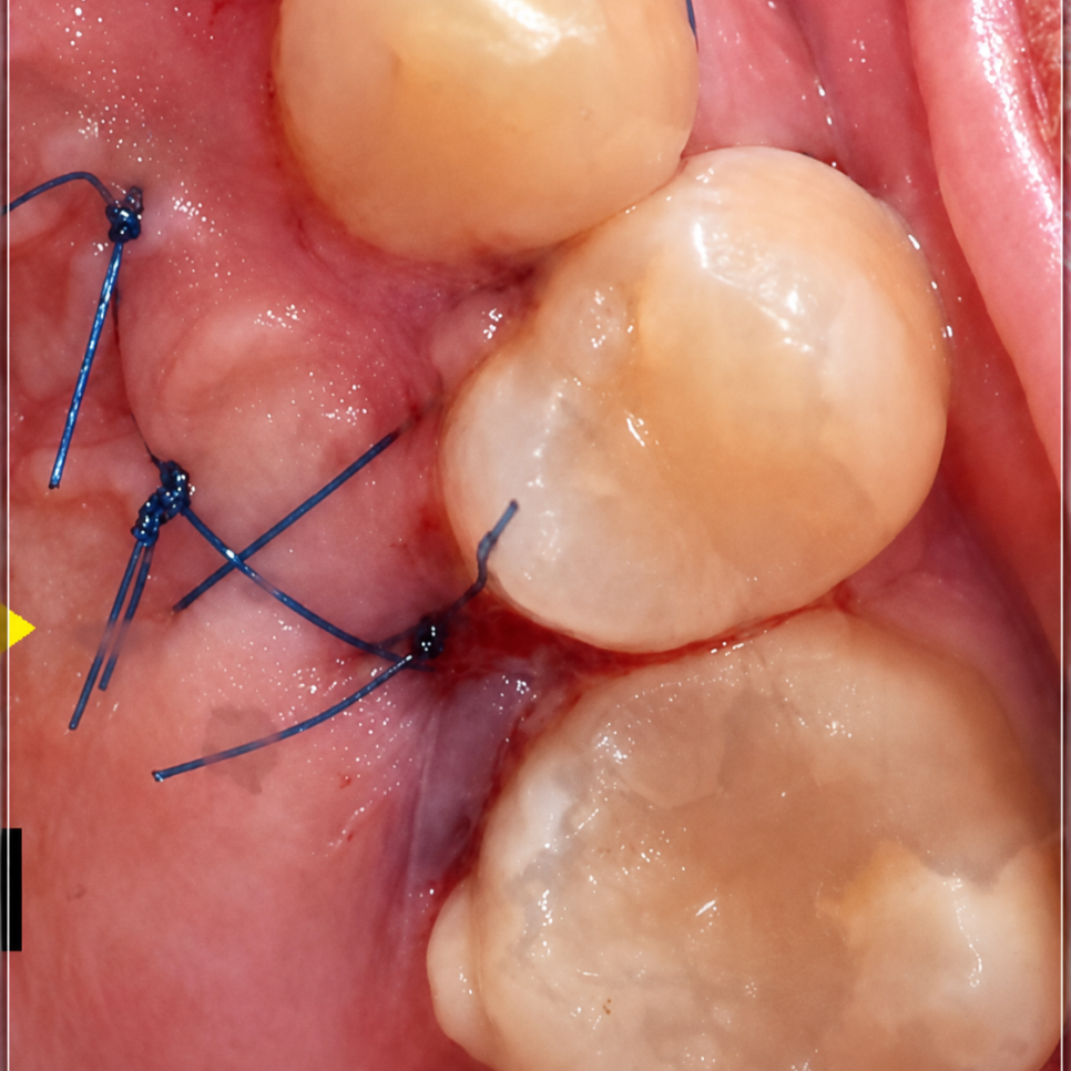 Is a University Hospital the Answer for Extracting a Completely Impacted Tooth? image 4