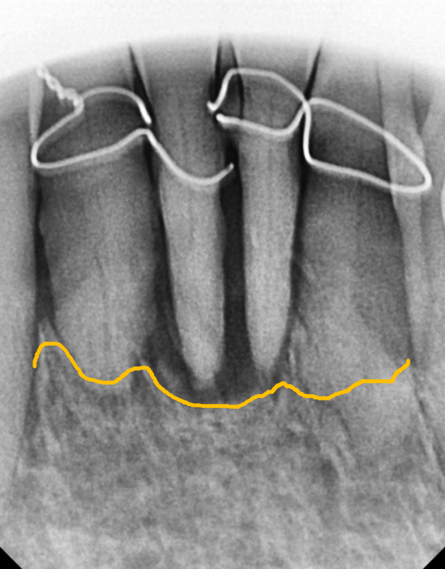 흔들리는 치아 묶어두는 잠간고정술, 오히려 잇몸뼈를 녹일 수도 있다고요? 관련 이미지 7