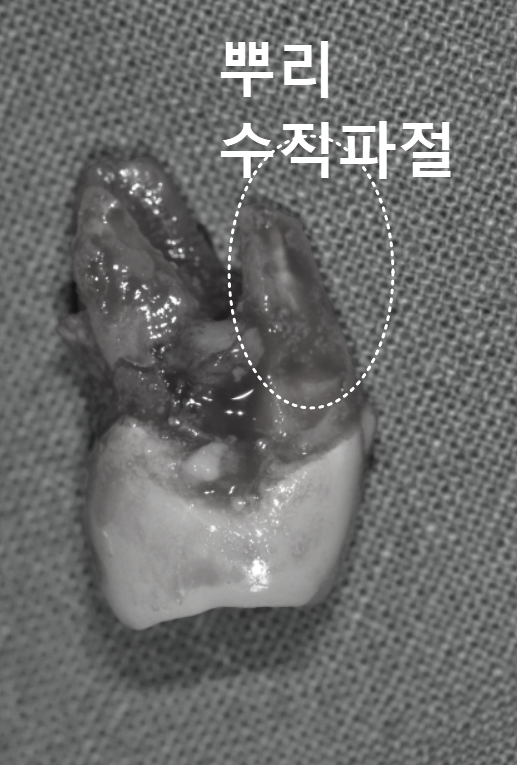 어금니 금 감, 치아 살릴 수 있는 기준은 바로 관련 이미지 11