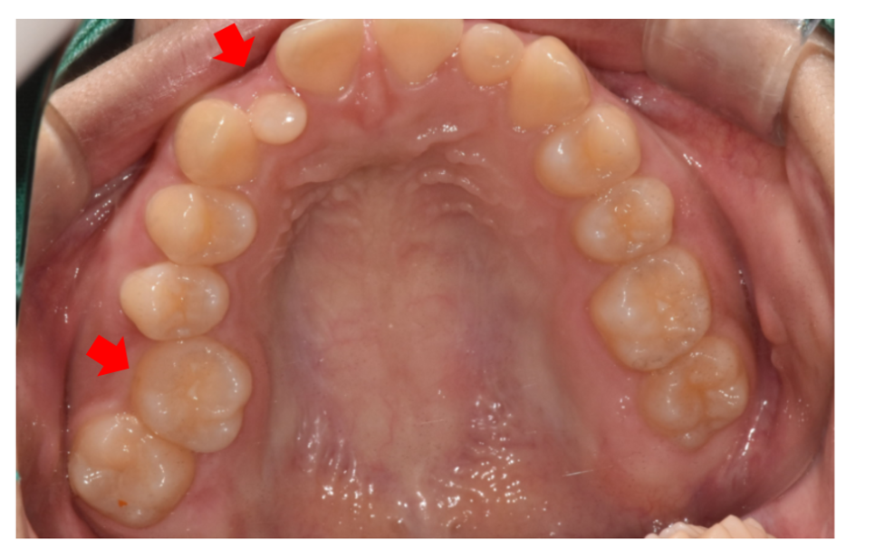 Microdontia Orthodontics Can Restore Balance and Alignment of the Teeth. image 4