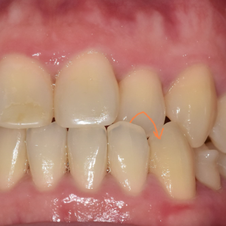 Sangil-dong Orthodontic Dentist: Do Protruding Front Teeth Really Need Orthodontic Treatment? image 4