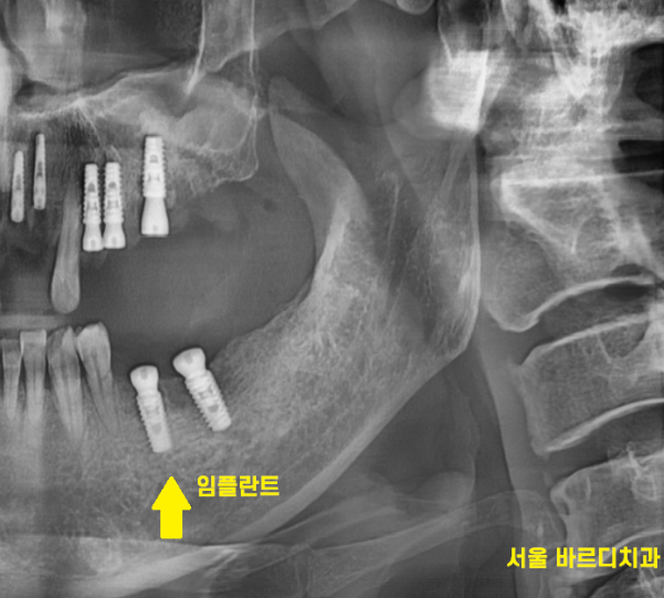 상일동역 치과에서 알려드리는 임플란트 수술과정 대공개 관련 이미지 4