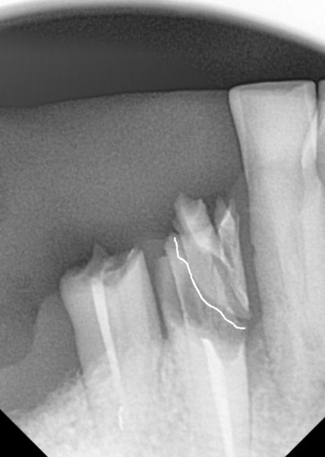 오래된 어금니 롱브릿지, 교체 타이밍을 놓치면 관련 이미지 8