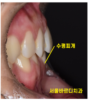 고덕동 교정치과 부정교합은 무엇인가요? 어떨때 치료가 필요한가요? 관련 이미지 6