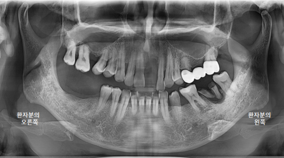고덕동치과 서울바르디치과 전치부 및 구치부 임플란트 치료증례 #9 관련 이미지 1