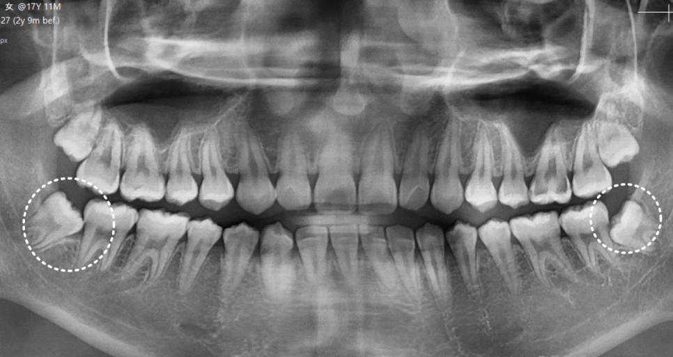 상일동 사랑니 매복 방치하다 옆 치아까지 망가진 실제 사례 관련 이미지 4