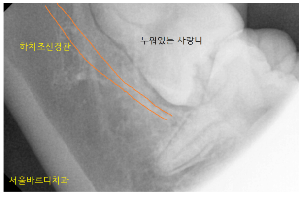 강동구 사랑니 묻혀있는 매복치아 꼼짝마!!! 뽑아줄테니까 관련 이미지 5