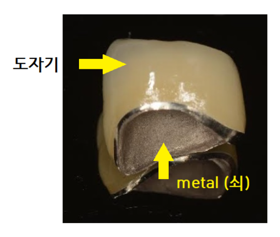 건강보험 임플란트 지르코니아 크라운 확대 길동 치과에서! 관련 이미지 2
