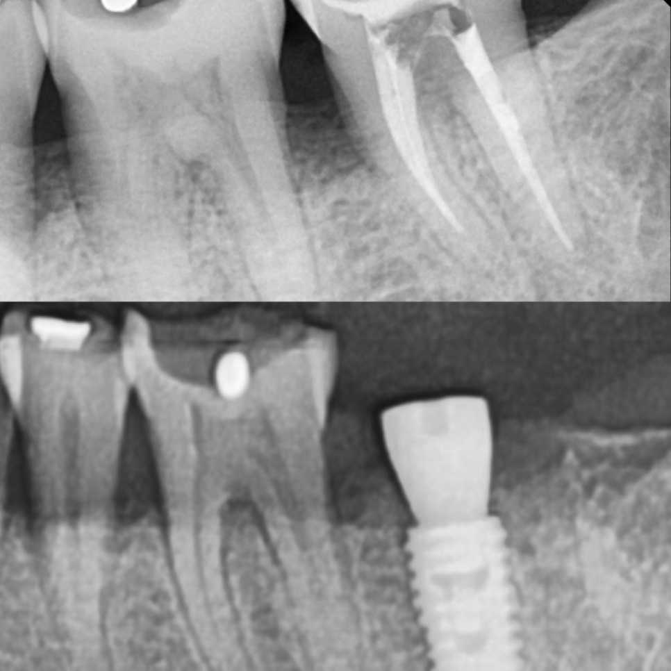 Implant Treatment for a Fractured Molar Split in Half After Neglect Following Root Canal Treatment image 4