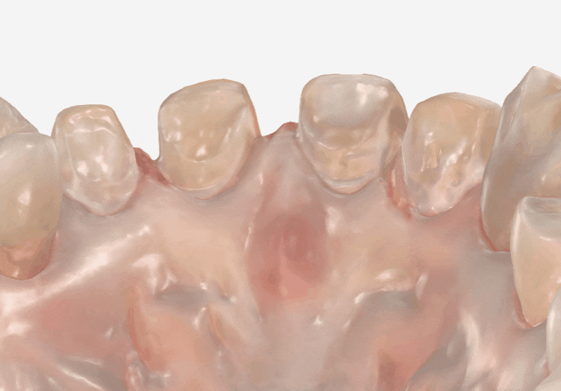 Gangdong-gu Dental Impressions: Are You Still Biting Down for 5 Minutes? We’ll Make It Comfortable with an Intraoral Scanner! image 4