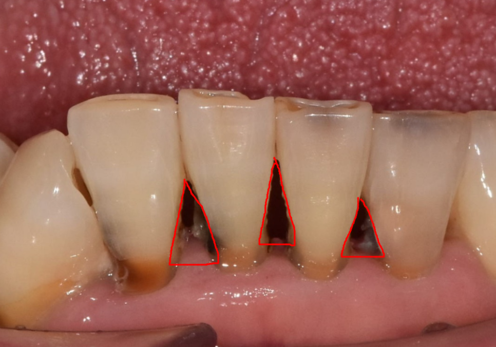 앞니 음식물 끼임, 왜 젊을 때보다 더 자주 발생하는 걸까요? 까맣게 변한 앞니 치료 사례 관련 이미지 2