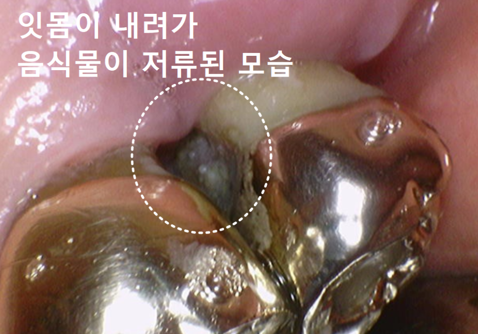 강동구 잇몸 퇴축으로 뿌리 드러난 치아, 이대로 둬도 괜찮을까? 관련 이미지 7